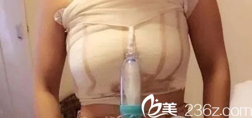 假體隆胸后4天