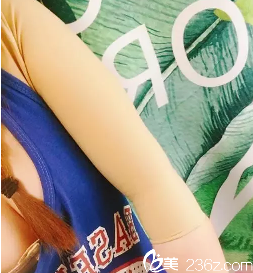 手臂吸脂半個(gè)月恢復(fù) 手臂吸脂半個(gè)月恢復(fù)