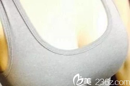 假體隆胸手術(shù)一個半月效果圖