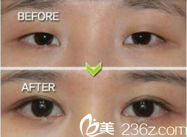 衡陽美萊雙眼皮前后對比