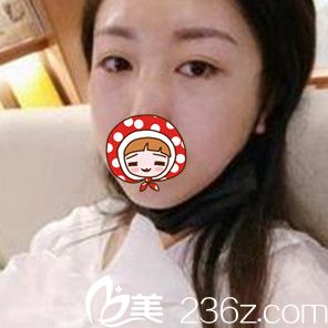 做內(nèi)切祛眼袋術(shù)后即刻<span style=