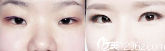 北京美萊整形美容醫(yī)院劉金華眼綜合手術(shù)效果對比圖 北京美萊整形美容醫(yī)院劉金華眼綜合手術(shù)效果對比圖