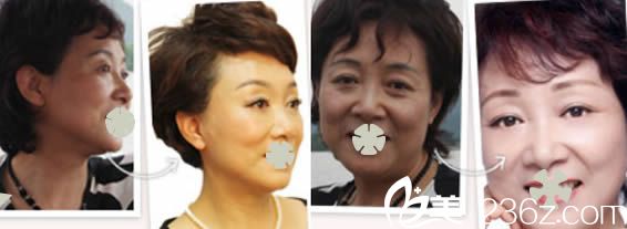 北京美萊向淑英醫(yī)生注射美膚效果對比圖 北京美萊向淑英醫(yī)生注射美膚效果對比圖