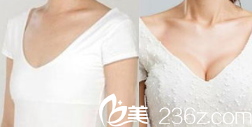 北京聯(lián)合麗格田孝臣胸部整形案例 北京聯(lián)合麗格田孝臣胸部整形案例