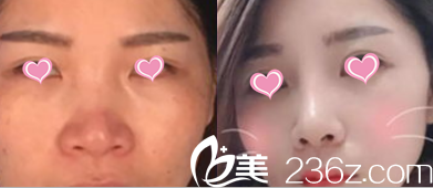 北京聯(lián)合麗格田孝臣鼻綜合案例 北京聯(lián)合麗格田孝臣鼻綜合案例