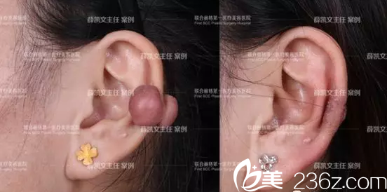 北京聯(lián)合麗格薛凱文去疤痕疙瘩案例 北京聯(lián)合麗格薛凱文去疤痕疙瘩案例