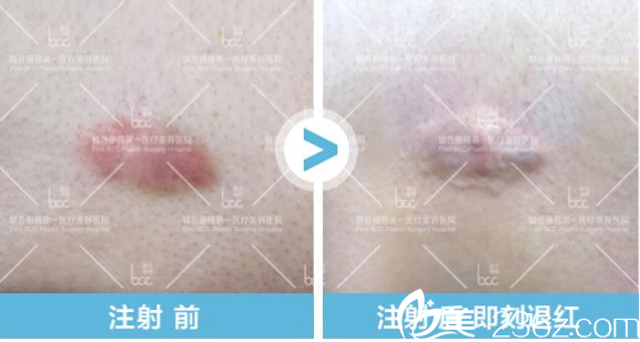 北京聯(lián)合麗格薛凱文疤痕針注射前后效果 北京聯(lián)合麗格薛凱文疤痕針注射前后效果