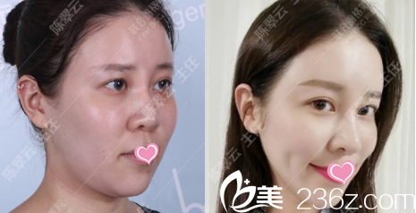 北京聯(lián)合麗格陳翠云線雕下頜緣提升案例 北京聯(lián)合麗格陳翠云線雕下頜緣提升案例