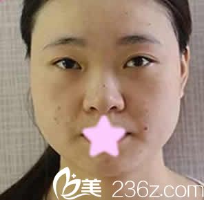 我在大同美神整形打瘦臉之前的照片 我在大同美神整形打瘦臉之前的照片