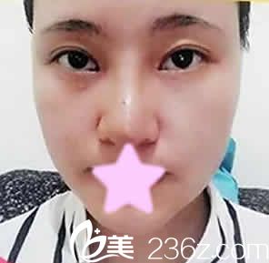 我在大同美神注射瘦臉后第3天照片 我在大同美神注射瘦臉后第3天照片