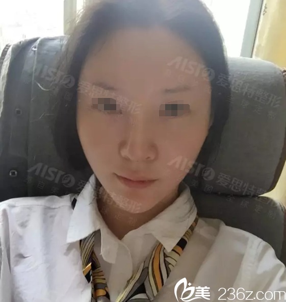 脂肪填充術(shù)后三天恢復