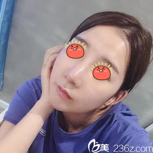 做完肋軟骨隆鼻7天拆線<span style= 做完肋軟骨隆鼻7天拆線<span style=