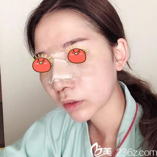 做完鼻綜合隆鼻手術(shù)3天圖片 做完鼻綜合隆鼻手術(shù)3天圖片