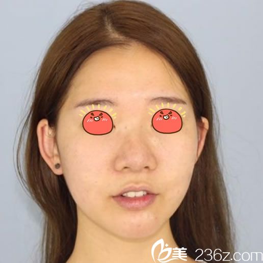 在寧波薇琳醫(yī)院做隆鼻手術(shù)前 在寧波薇琳醫(yī)院做隆鼻手術(shù)前