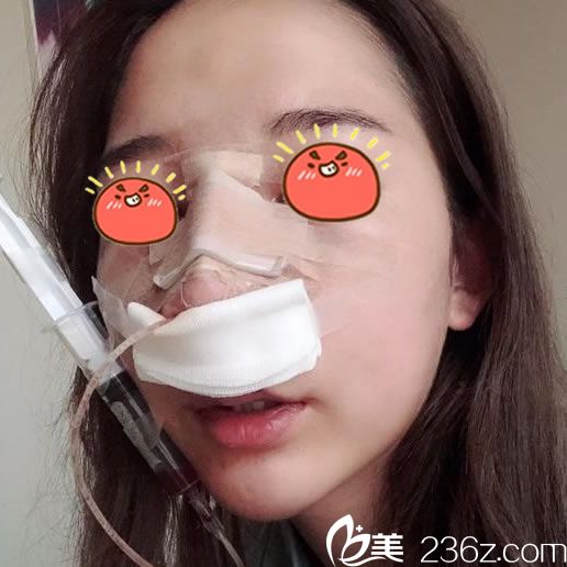 寧波薇琳張文巍隆鼻手術(shù)當天照片 寧波薇琳張文巍隆鼻手術(shù)當天照片