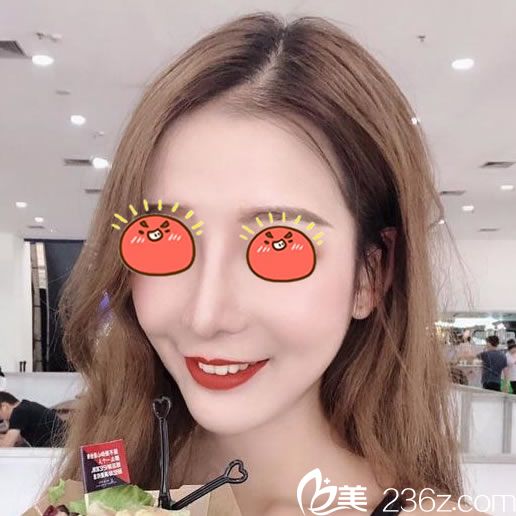 做完肋軟骨隆鼻30天恢復(fù)圖片 做完肋軟骨隆鼻30天恢復(fù)圖片