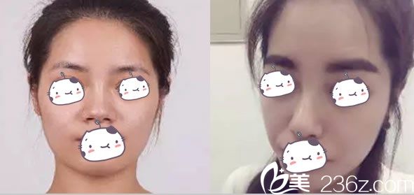 佛山華美整形羅玉康醫(yī)生鼻部整形前后效果圖 佛山華美整形羅玉康醫(yī)生鼻部整形前后效果圖