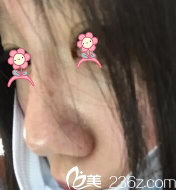 鄭州麗天玻尿酸注射隆鼻術(shù)后2天