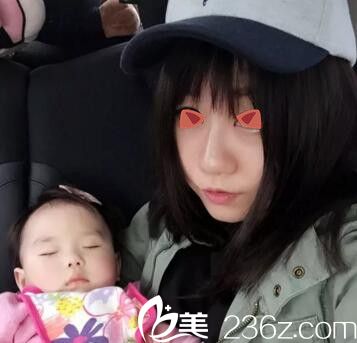 鄭州麗天玻尿酸注射隆鼻術(shù)后31天