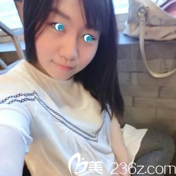 鄭州麗天玻尿酸注射隆鼻術(shù)后36天