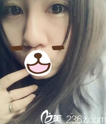 寶媽我在鄭州麗天做玻尿酸注射隆鼻 案例前后對(duì)比照分享給大家