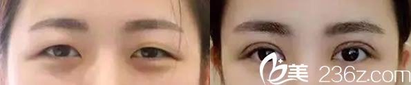 雷朝勇醫(yī)生全切雙眼皮代表案例 雷朝勇醫(yī)生全切雙眼皮代表案例