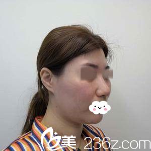 手術(shù)前的我 手術(shù)前的我