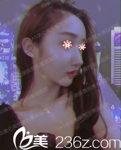 重慶美侖美奐施問國面部線雕提升術(shù)后30天