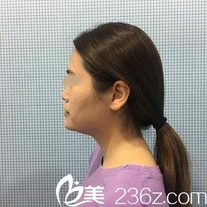 手術前的我 手術前的我