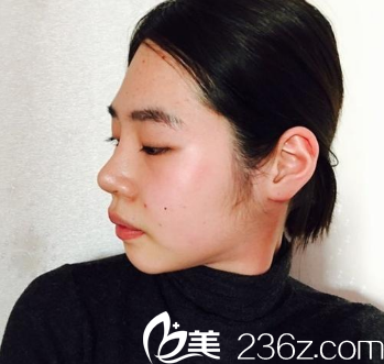 在廣州曙光整形醫(yī)院做脂肪填充手術(shù)前 在廣州曙光整形醫(yī)院做脂肪填充手術(shù)前