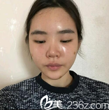 廣州曙光自體脂肪填充術(shù)后三天 廣州曙光自體脂肪填充術(shù)后三天