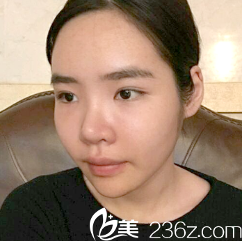 廣州曙光自體脂肪填充術(shù)后7天效果 廣州曙光自體脂肪填充術(shù)后7天效果