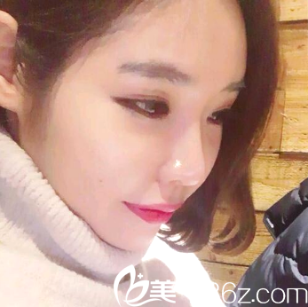 自體脂肪填充全臉術(shù)后15天自拍 自體脂肪填充全臉術(shù)后15天自拍