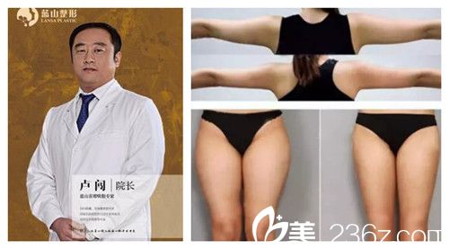 盧闖醫(yī)生吸脂案例