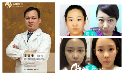 王興奎醫(yī)生雙眼皮案例