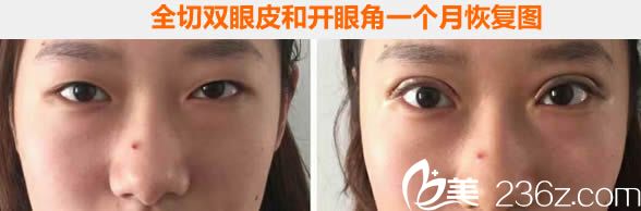 蘭州夢想整形全切雙眼皮和開眼角1個月恢復<span style= 蘭州夢想整形全切雙眼皮和開眼角1個月恢復<span style=