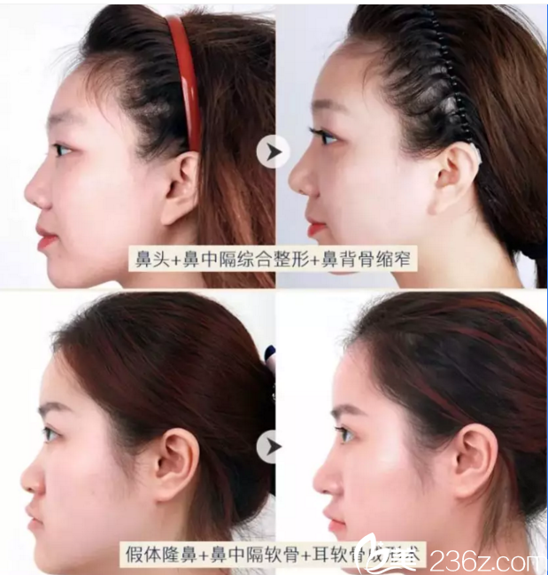 魯禮新鼻部整形真人案例