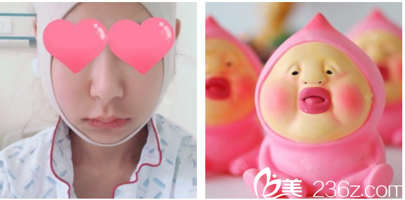 整形醫(yī)生羅奇博士做的下頜角術(shù)后第二天