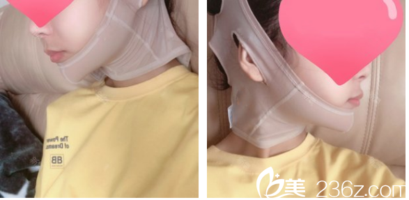 下頜角磨骨七天拆線效果圖