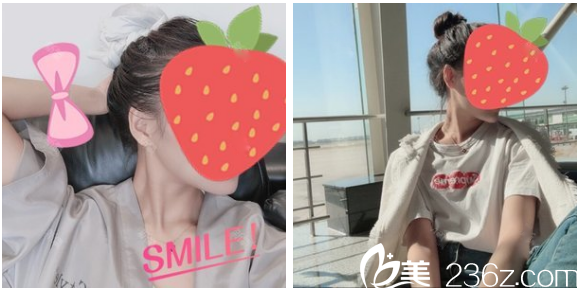 深圳非凡羅奇博士做的下頜角磨骨真人案例