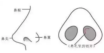 單純隆鼻術(shù)解析