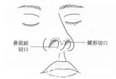 鼻綜合整形術(shù)解析