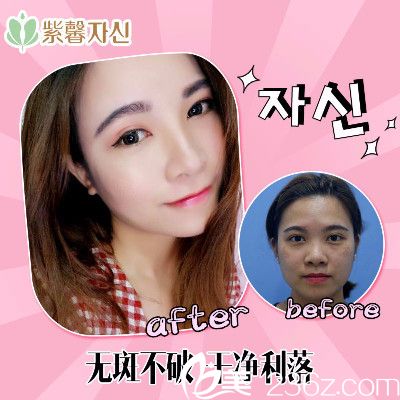 廣州紫馨整形醫(yī)院超皮秒祛黃褐斑案例圖片