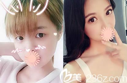 福州名韓林峰個人案例雙眼皮前后對比圖 福州名韓林峰個人案例雙眼皮前后對比圖