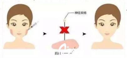 臉部多久能消腫？