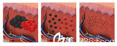 超皮秒祛黃褐斑過程圖片