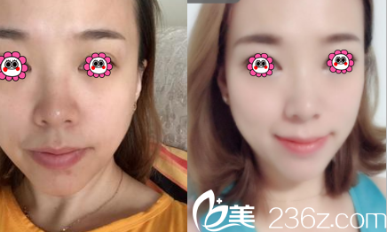 北京華韓趙子涓熱瑪吉美膚案例 北京華韓趙子涓熱瑪吉美膚案例