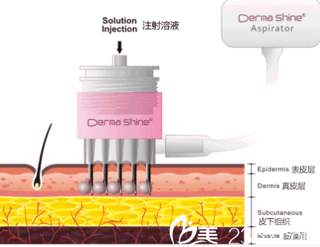水光嫩膚示意圖 水光嫩膚示意圖