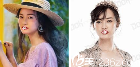 重慶銅雀臺(tái)面部線雕案例對比 重慶銅雀臺(tái)面部線雕案例對比