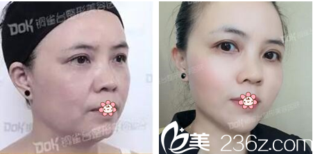 重慶銅雀臺(tái)線雕提拉法令紋眼周紋案例 重慶銅雀臺(tái)線雕提拉法令紋眼周紋案例